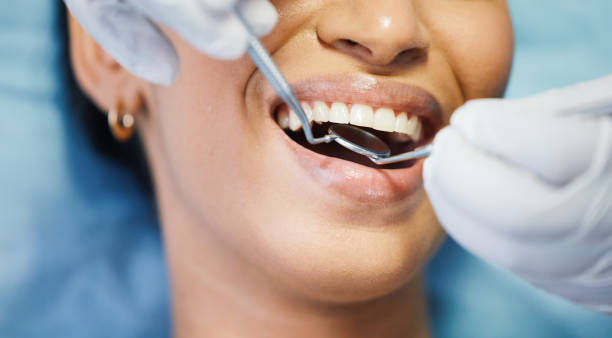 Best Knocked-Out Tooth (Avulsed Tooth) Treatment in Shelby, MT